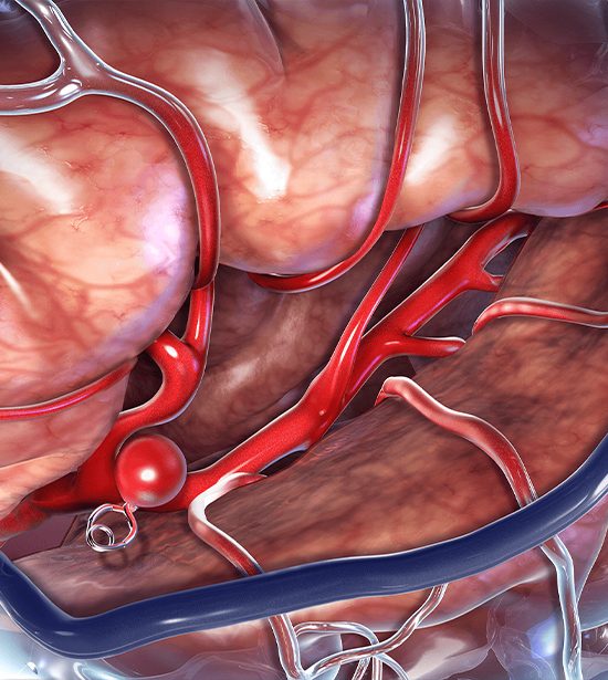 Brain Aneurysms & Arteriovenous Malformations