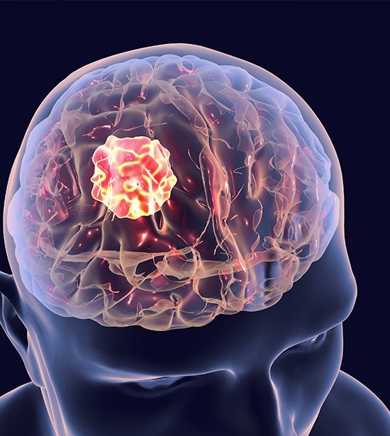 Brain Tumours