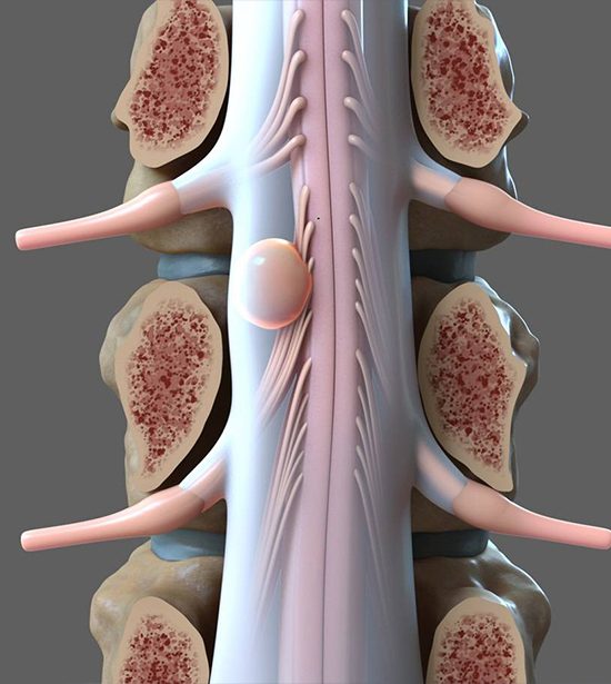 Spinal Cord Tumours
