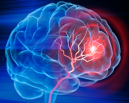 Brain Aneurysms & Arteriovenous