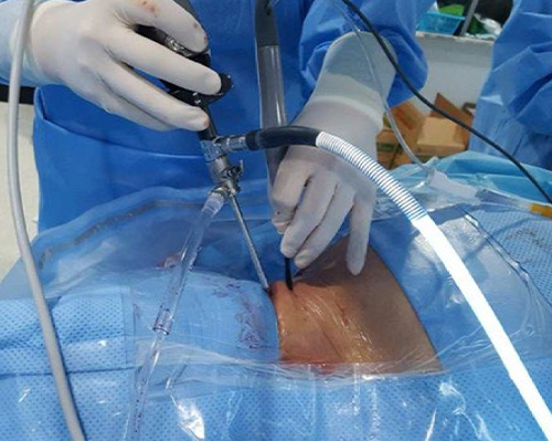 Microscopic Spine Surgery