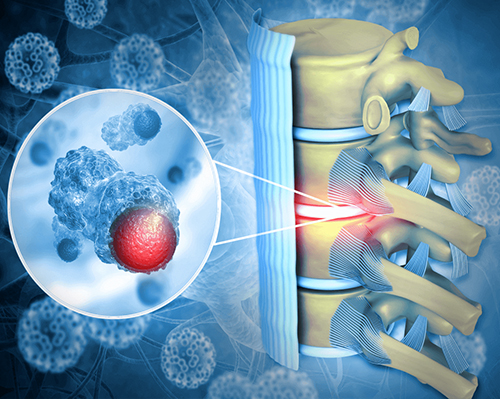 Spinal Cord Tumours