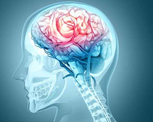 Traumatic Brain Injuries