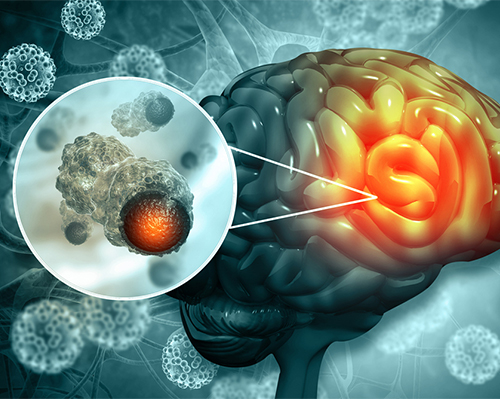 Brain Tumours
